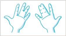Polydactyly & Syndactyly